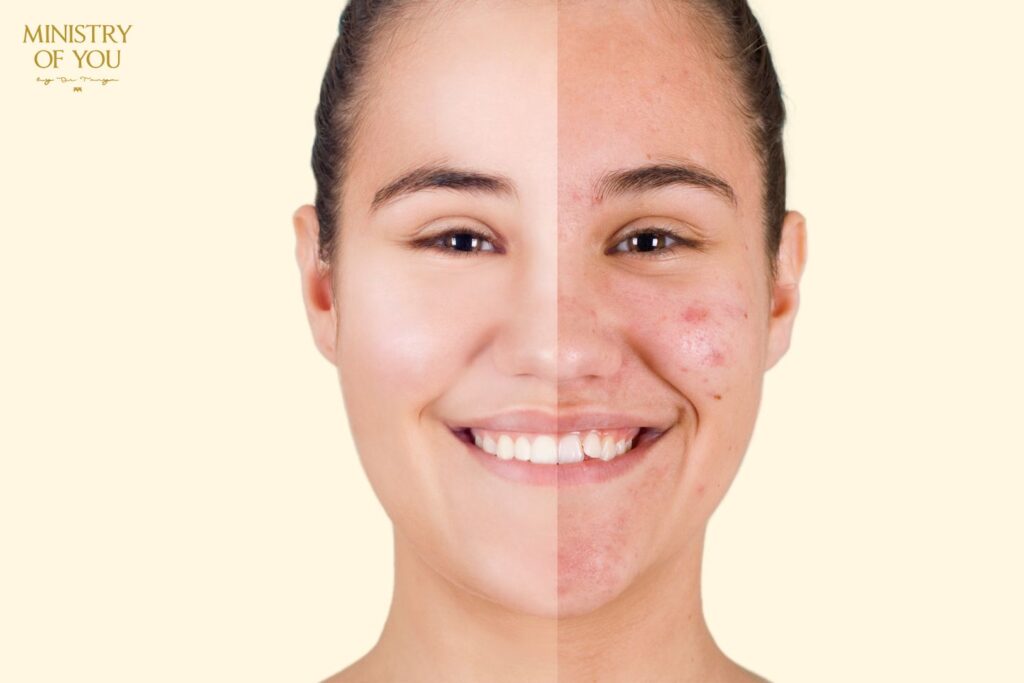 Acne Facial 1 Expert Acne Facial Treatment in Mohali