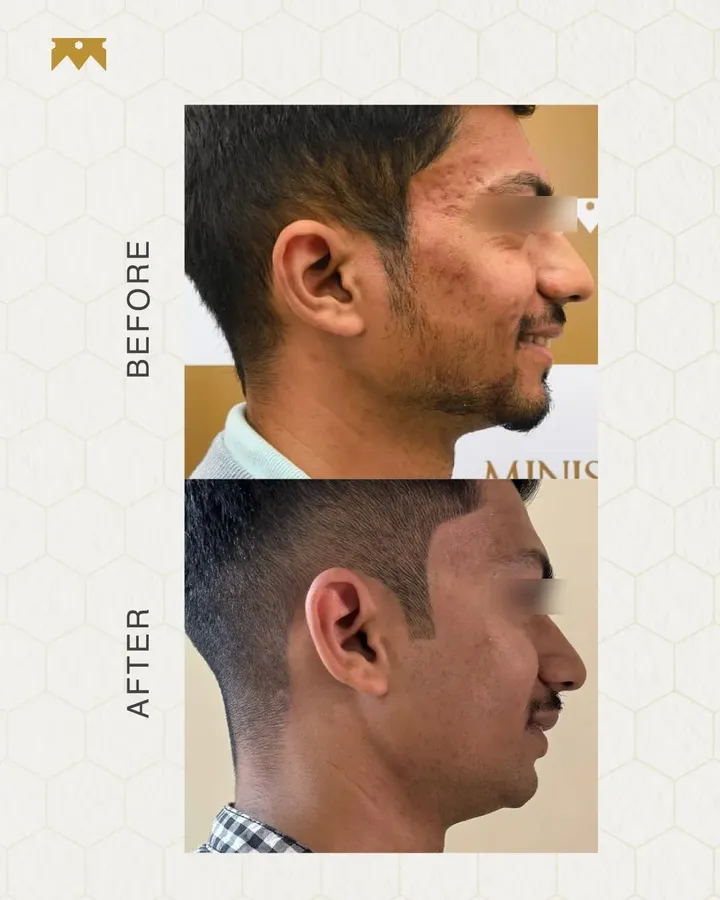Acne Facial 2