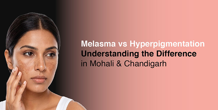 Melasma vs Hyperpigmentation